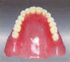【入れ歯　保険】熱可塑性義歯