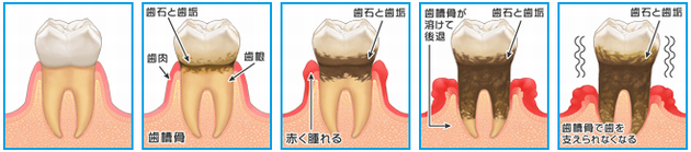 歯周病の進行
